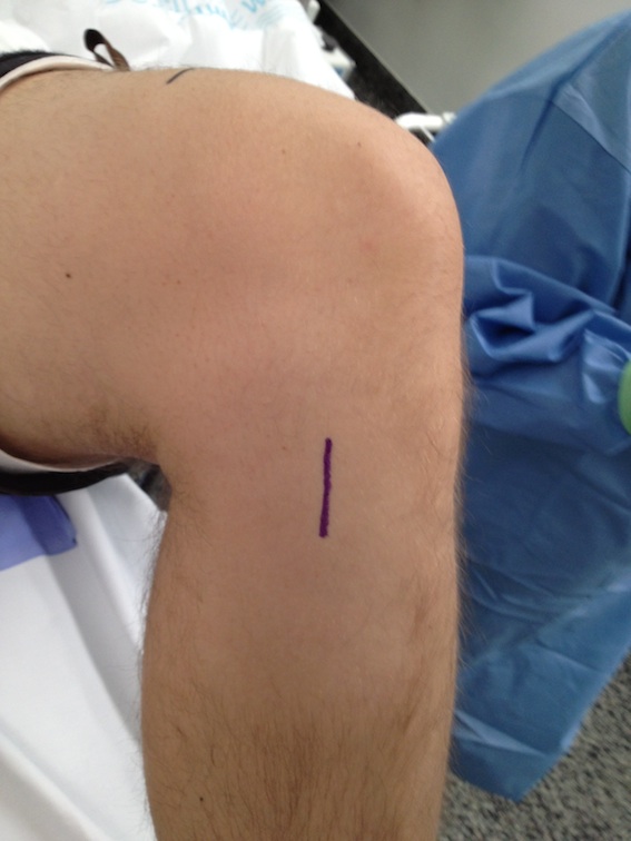 Hamstring Autograft The Bone School